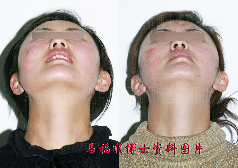 颧骨颧弓整形仰头位