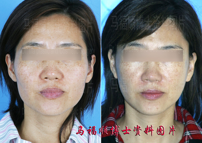 改脸型与面部提升