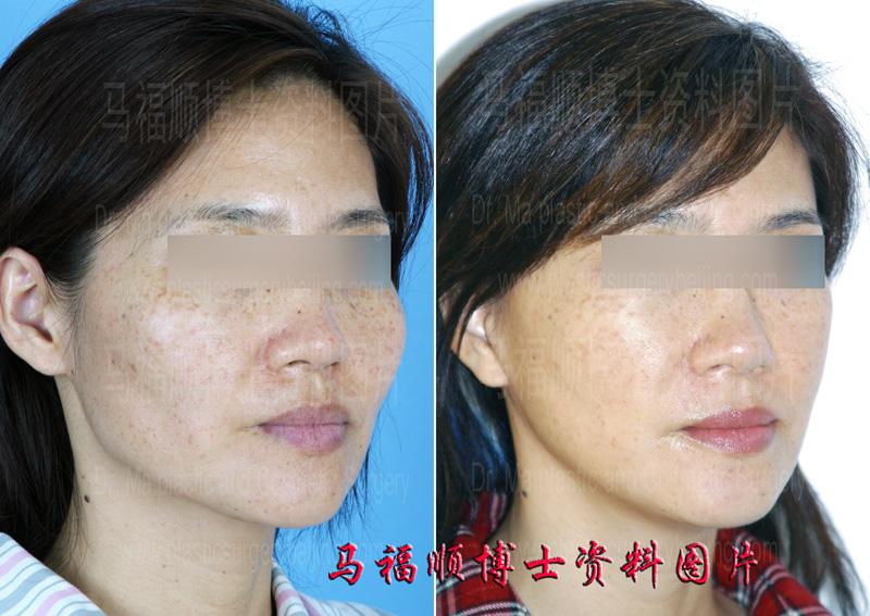 颧骨颧弓整形面部年青化