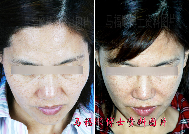 颧骨颧弓整形俯视位