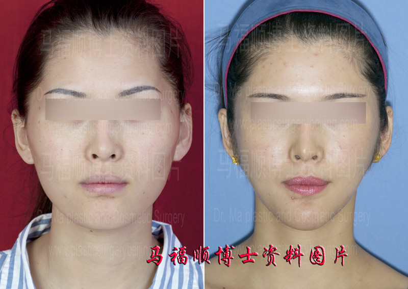 颌面综合整形改脸型