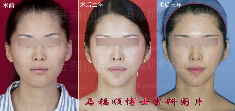 颌面综合整形改脸形