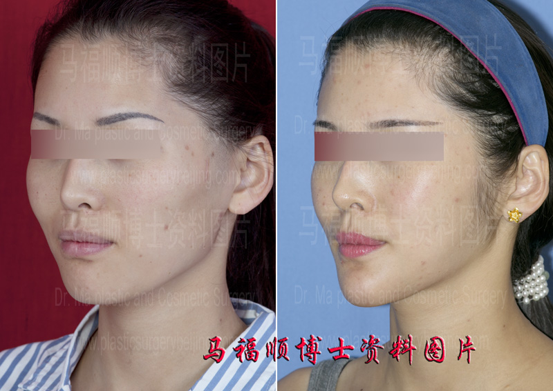 颌面综合整形侧面