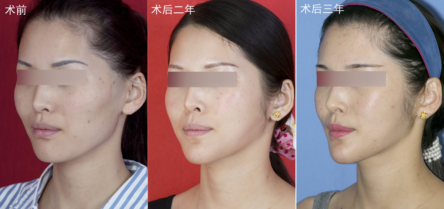 颌面综合整形侧面