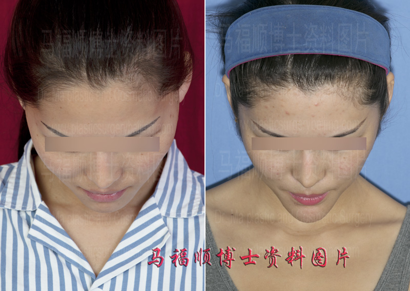 颧骨颧弓整形对比