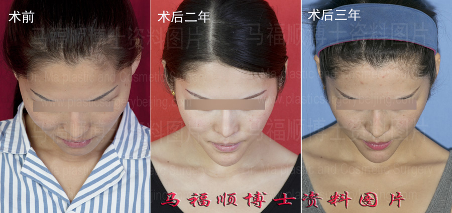 颧弓颧弓整形低头位对比