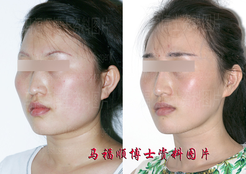 大脸变小脸斜位