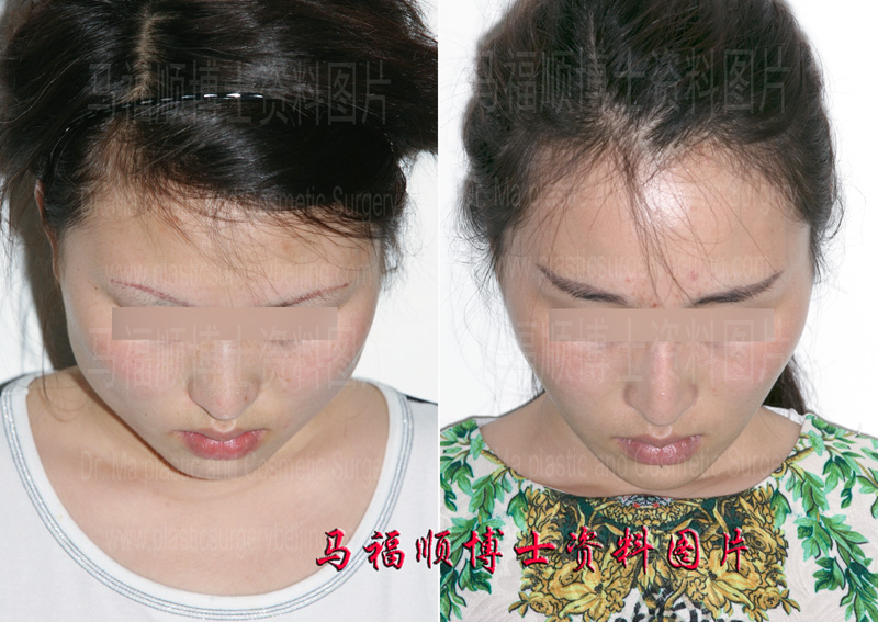 大脸变小低头位