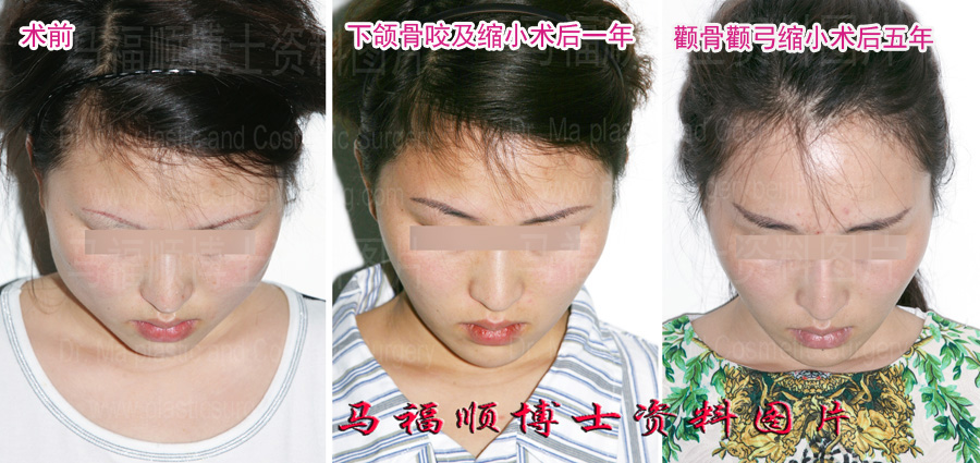 大脸变小低头位1