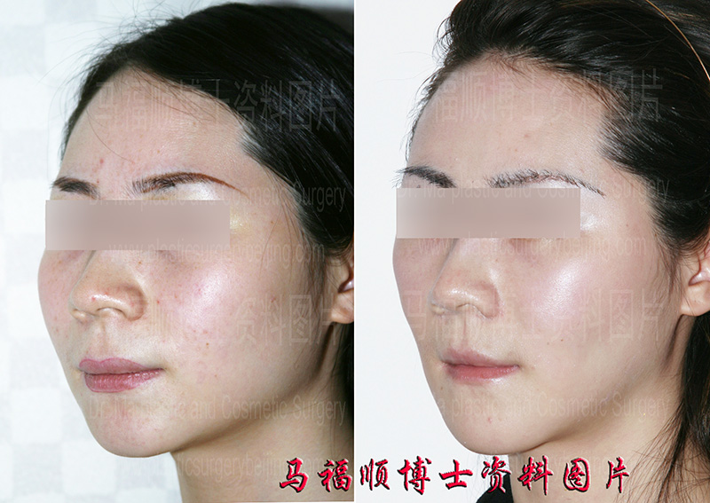 一次性大脸变小手术