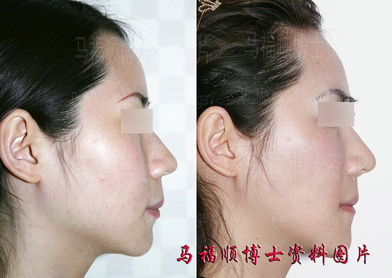 一次手术大脸变小侧面