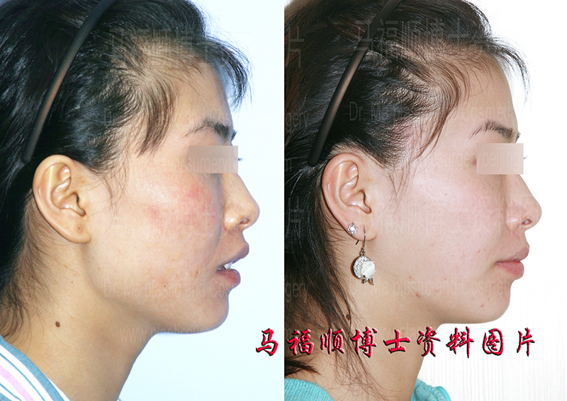 大脸盘变小术前术后