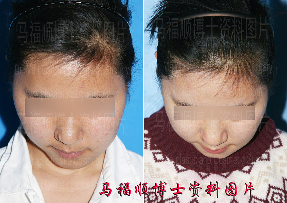 颧骨下颌骨整形治疗面部不对称