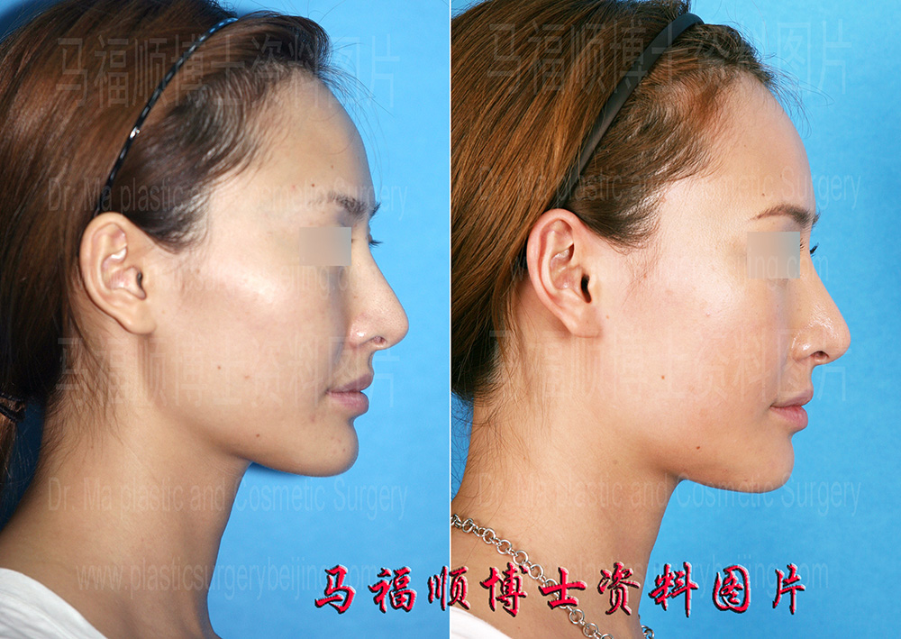 颧骨颧弓舒平术脸型变柔和侧面