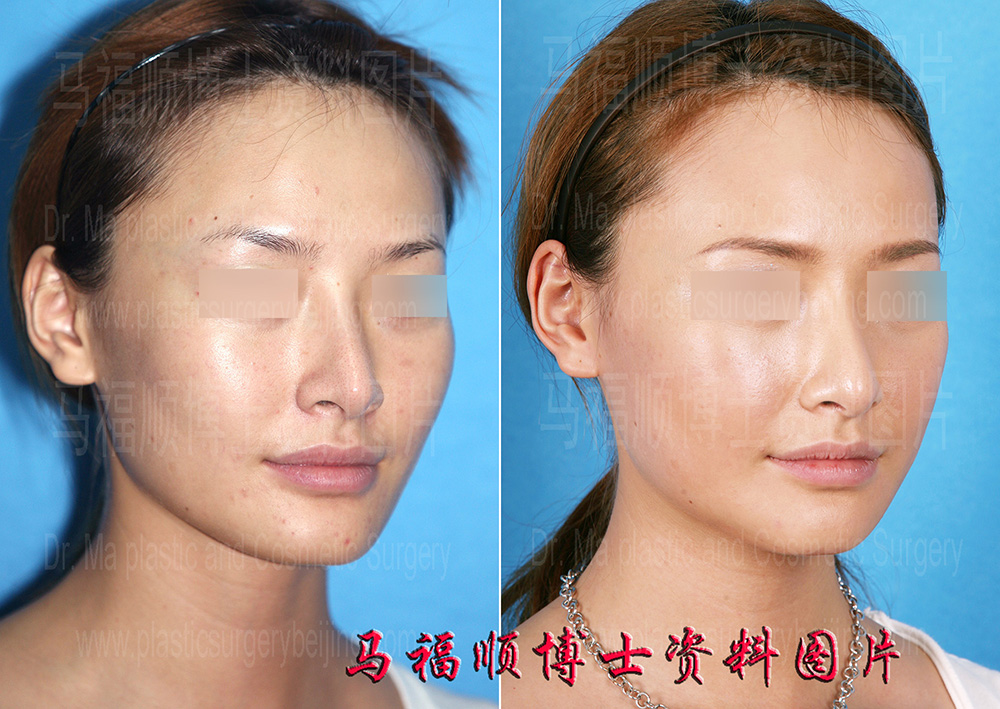 颧骨颧弓舒平后颧骨突出消失