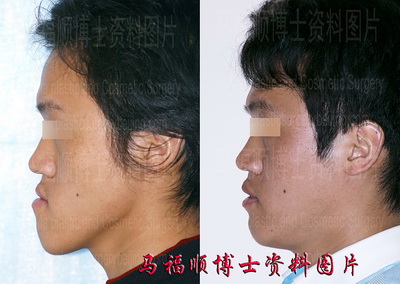 反颌整形让笑容灿烂