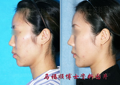 颏前移修复膨体植入不良效果