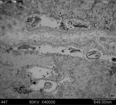 注射A型肉毒素引起的人类咬肌超微结构变化 (Ultrastructrual Changes in Human Masseter Muscles after Botulinum Neurotoxin A)