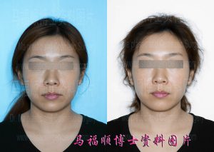 上下颌后推 人中缩短