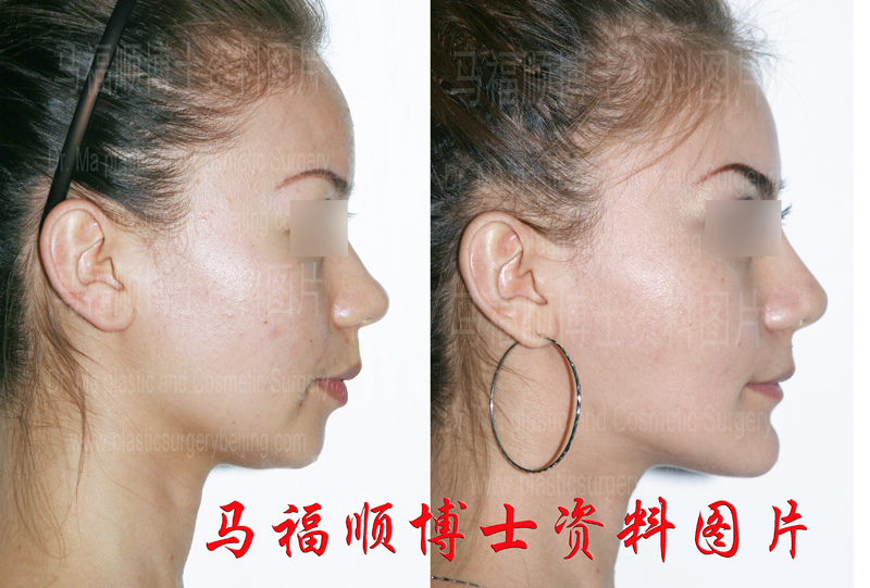 下颌角及颏前移整形后侧面变化